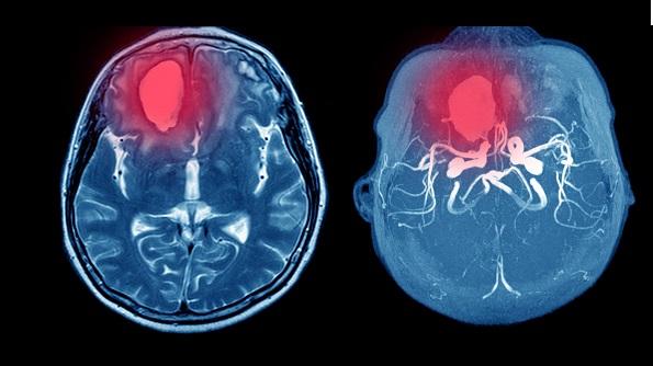 Largest Study of VITT After COVID-19 Vaccination Digs Into Lab, Clinical Features